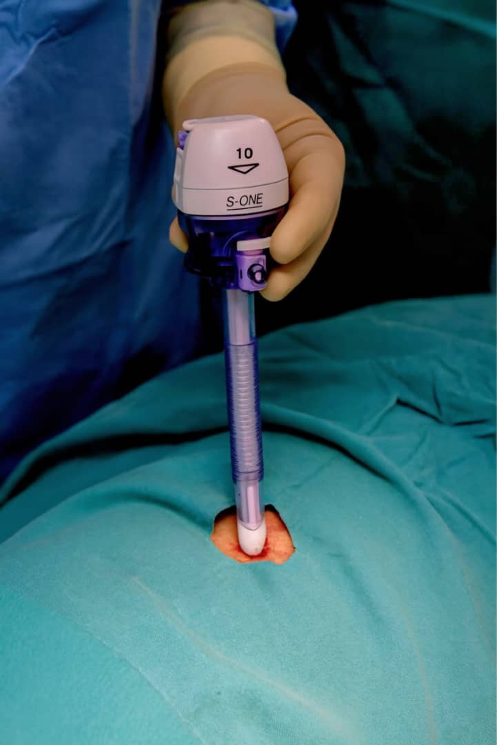 ساخت تروکار یک‌بار مصرف لاپاراسکوپی توسط یک شرکت دانش‌بنیان